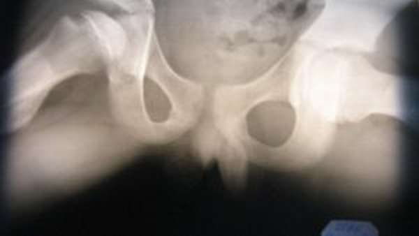 Остеопороз и рентген
